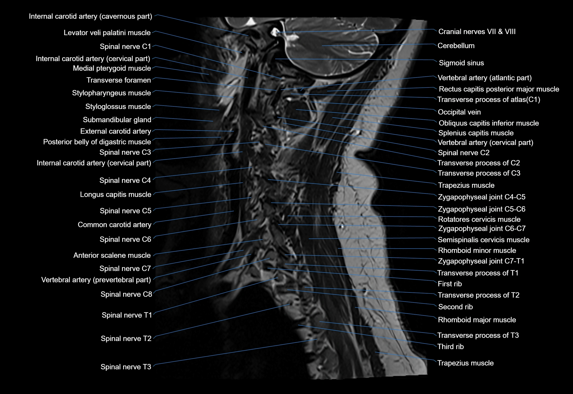 cervical spine cross sectional MRI anatomy 3T MRI  sagittal image-img-00001-00006.webp